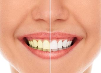 3 Tips to Pick Dental Office | Teeth Whitening Moreno Valley