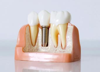 5 Signs You May Need Dental Implants in Moreno Valley 5 Signs You May Need Dental Implants in Moreno Valley