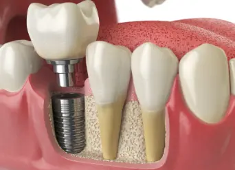Bone Grafts Before Dental Implants: Moreno Valley Helpful dental information about dental implants Moreno Valley