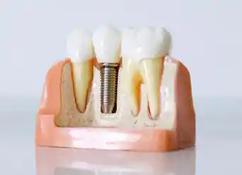 Common Myths About Dental Implants in Moreno Valley Common Myths About Dental Implants in Moreno Valley
