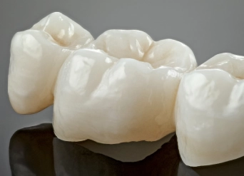 Close-up of realistic ceramic tooth restorations for Dental Crowns in Moreno Valley
