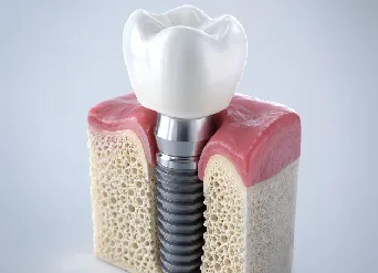 Dental implant model showing a titanium post, abutment, and crown, representing dental implants in Moreno Valley and the implant recovery process
