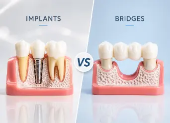 Implants vs Bridges: Which Option Fits Your Smile? Helpful dental information about dental implants Moreno Valley