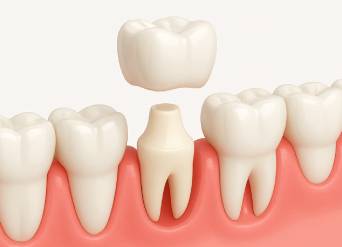 Five Key Reasons to Get Dental Crowns in Moreno Valley Five Key Reasons to Get Dental Crowns in Moreno Valley
