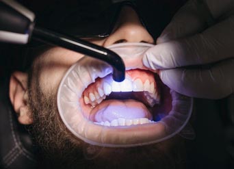 blue light during teeth whitening treatment in Moreno Valley
