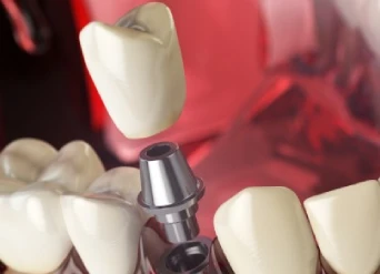 The Process of Getting Dental Implants in Moreno Valley
