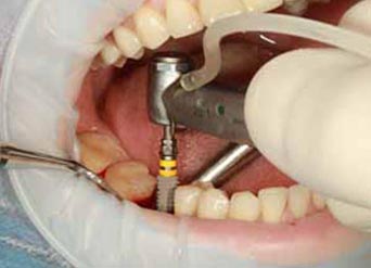  What to Expect During First Dental Implants?
