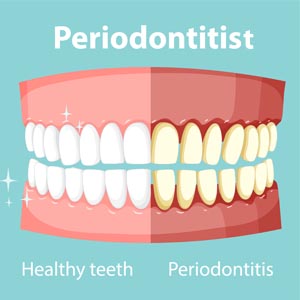 Why See a Periodontist Before Dental Implants | Moreno Valley