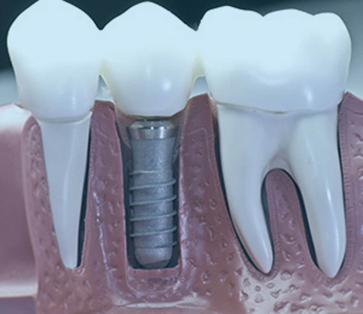 Dental-Implants