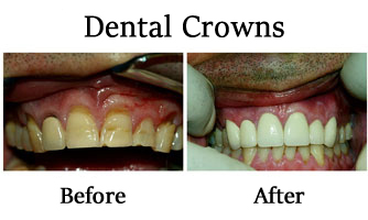 Dental Crowns 1