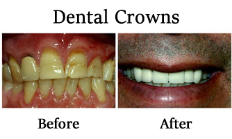 Dental Crowns 2