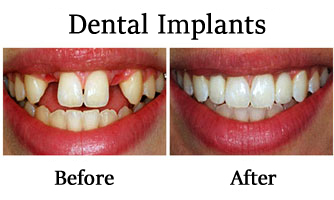 Dental Implants 3