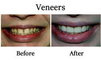 Veneers 1