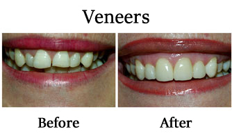 Veneers 2